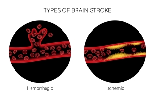 Types of Brain Strokes Types of Brain Strokes